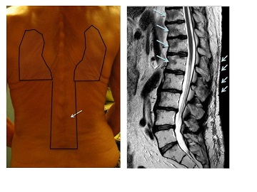 patient_avec_plexite_des_membres_inferieurs_-_copie