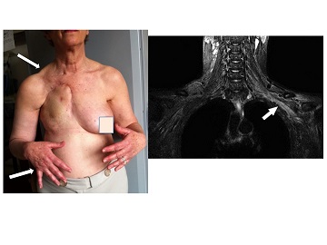 patiente_avec_plexite_du_membre_superieur_-_copie
